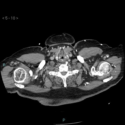 File:Aortic intramural hematoma (Radiopaedia 48463-53380 C 6).jpg