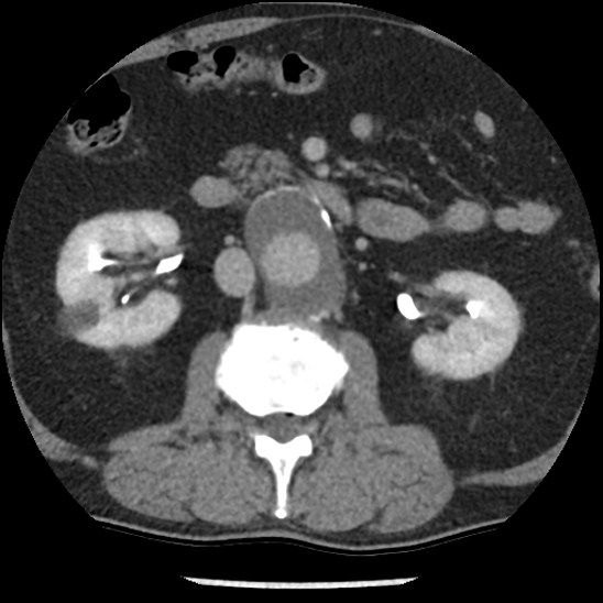 Aortic intramural hematoma (type B) (Radiopaedia 79323-92387 Axial C+ delayed 70).jpg