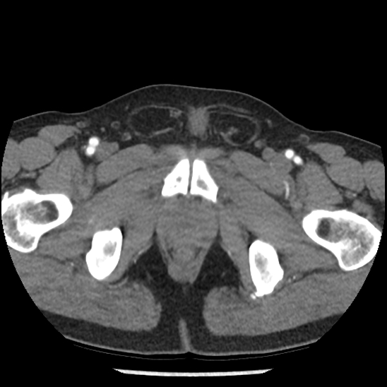 Aortic intramural hematoma (type B) (Radiopaedia 79323-92387 B 118).jpg