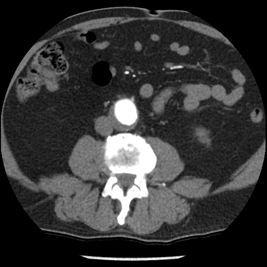 File:Aortic intramural hematoma (type B) (Radiopaedia 79323-92387 B 79).jpg
