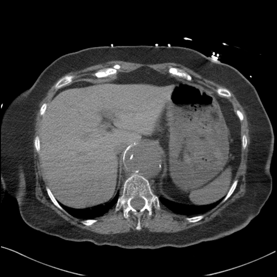 Aortic intramural hematoma with dissection and intramural blood pool (Radiopaedia 77373-89491 Axial non-contrast 90).jpg