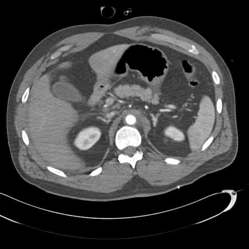 Aortic transection, diaphragmatic rupture and hemoperitoneum in a complex multitrauma patient (Radiopaedia 31701-32622 A 91).jpg