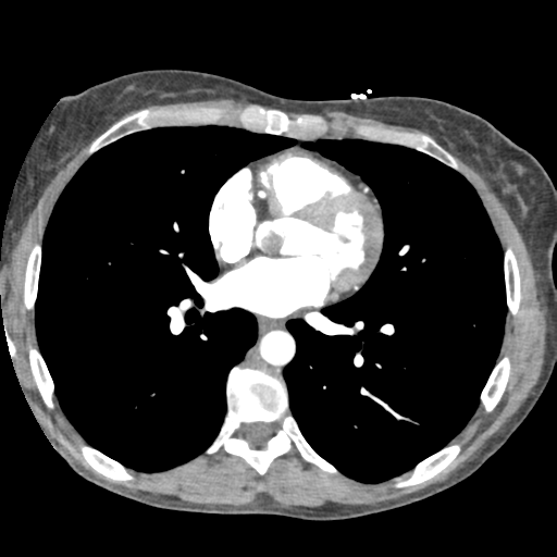 File:Aortic valve non-coronary cusp thrombus (Radiopaedia 55661-62189 A 23).png