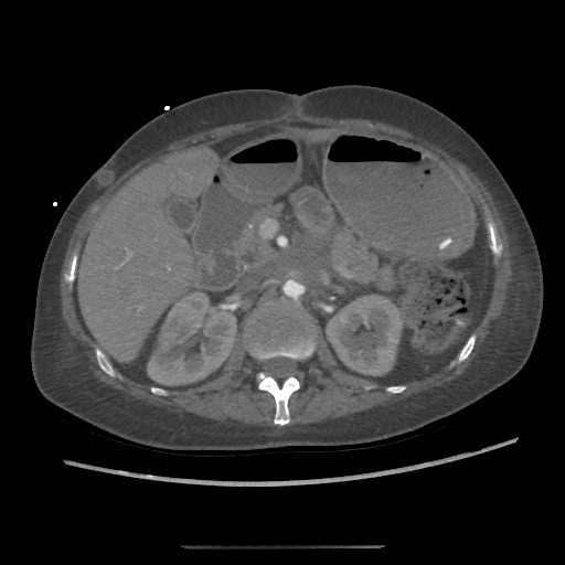 Aorto-duodenal fistula (Radiopaedia 25668-25850 A 20).jpg