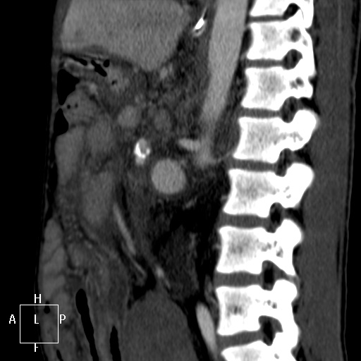 Aorto-left renal vein fistula (Radiopaedia 45534-49628 C 41).jpg