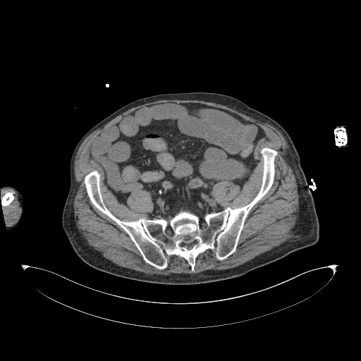 Aortoduodenal fistula (Radiopaedia 75286-86415 Axial non-contrast 54).jpg