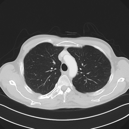 Apical pleural calcification (Radiopaedia 46141-50499 Axial lung window 20).png