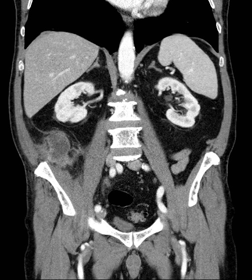 File:Appendiceal adenocarcinoma complicated by retroperitoneal abscess (Radiopaedia 58007-65039 A 48).jpg