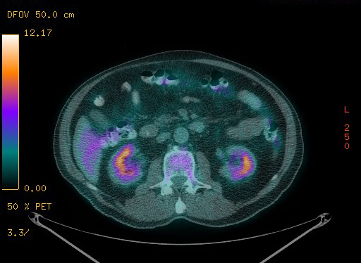 Appendiceal adenocarcinoma complicated by retroperitoneal abscess (Radiopaedia 58007-65041 Axial PET-CT 123).jpg
