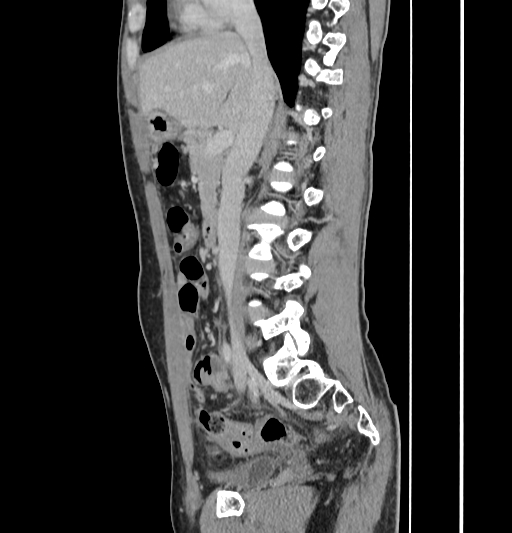 Appendiceal mucinous adenocarcinoma (Radiopaedia 66605-75922 C 28).jpg