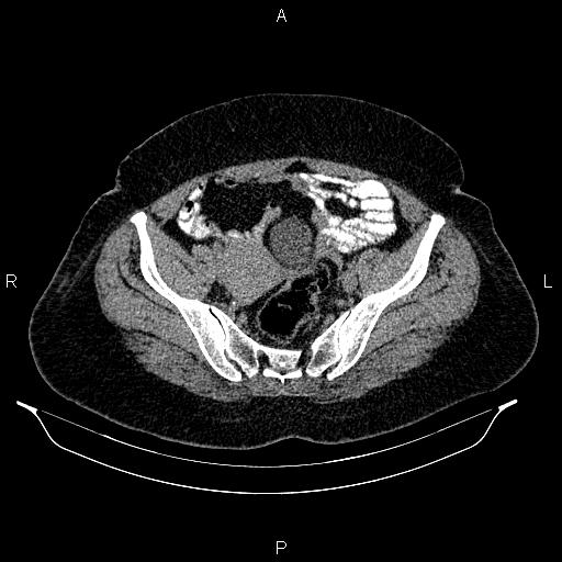 Appendiceal mucocele (Radiopaedia 86415-102460 Axial non-contrast 44).jpg