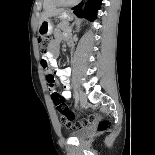 Appendicitis complicated by post-operative collection (Radiopaedia 35595-37114 C 44).jpg