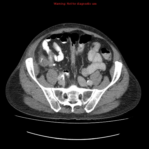 File:Appendicitis mass in inguinal hernia (Radiopaedia 26858-27029 A 9).jpg