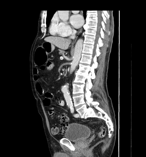 Appendicitis with localized perforation and abscess formation (Radiopaedia 49035-54130 C 34).jpg