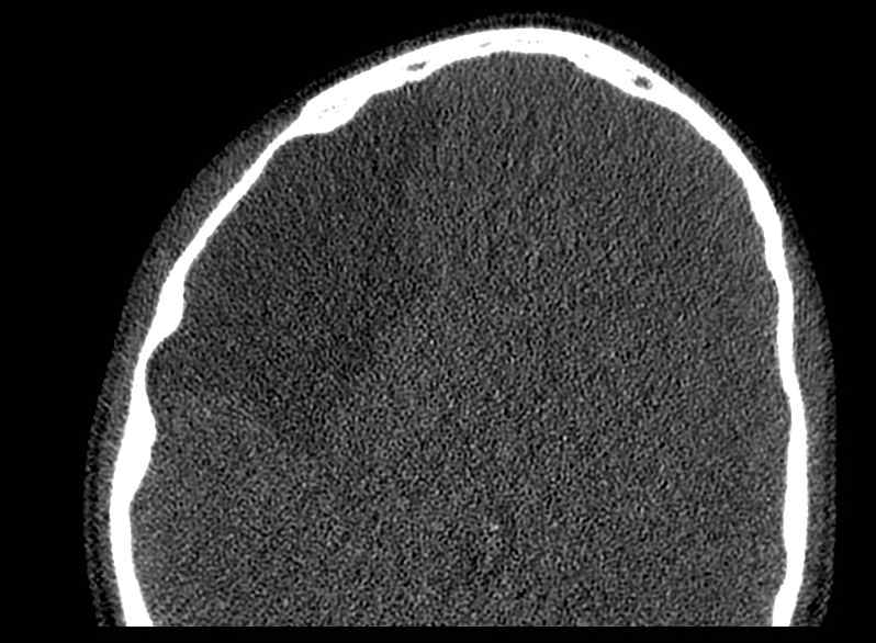 Arachnoid cyst- extremely large (Radiopaedia 68741-78450 Axial bone window 58).jpg