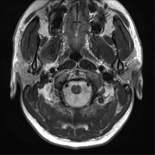 File:Arachnoid cyst - cerebellopontine angle (Radiopaedia 59689-67083 Axial T2 5).png