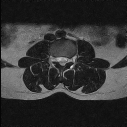 File:Arachnoid cyst - spinal (Radiopaedia 66835-76157 Axial T2 20).jpg