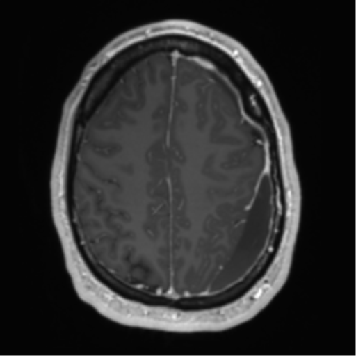 Arachnoid cyst with subdural hematoma (Radiopaedia 85892-101743 Axial T1 C+ 64).png