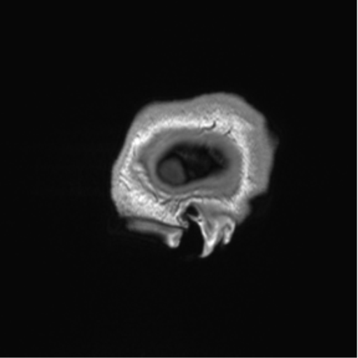 Arachnoid cyst with subdural hematoma (Radiopaedia 85892-101743 Sagittal T1 6).png
