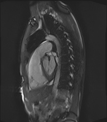 File:Arrhythmogenic right ventricular cardiomyopathy (Radiopaedia 57972-64966 Cine RVOT SSFP 24).jpg