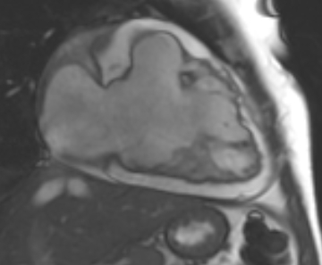 Arrhythmogenic right ventricular cardiomyopathy (Radiopaedia 69431-79307 2ch cine 73).jpg