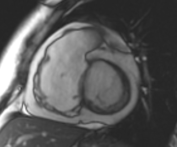 File:Arrhythmogenic right ventricular cardiomyopathy (Radiopaedia 69431-79307 Short axis cine 161).jpg