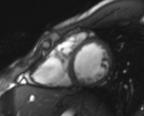 File:Arrhythmogenic right ventricular cardiomyopathy (Radiopaedia 69564-79464 short axis cine 120).jpg