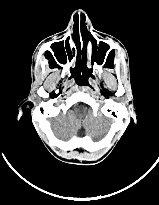 Arrow injury to the brain (Radiopaedia 72101-82607 Axial non-contrast 52).jpg