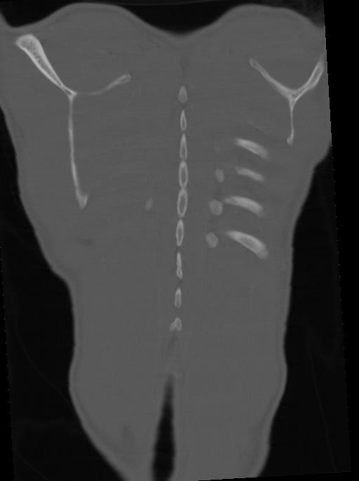 Arrow injury to the neck (Radiopaedia 75225-86323 Coronal bone window 107).jpg