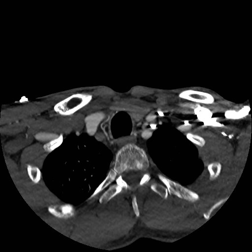 Artery of Percheron infarct (Radiopaedia 48088-52894 A 26).jpg
