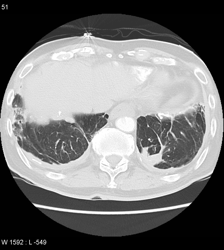 Asbestos related lung and pleural disease (Radiopaedia 14377-14301 A 48).jpg