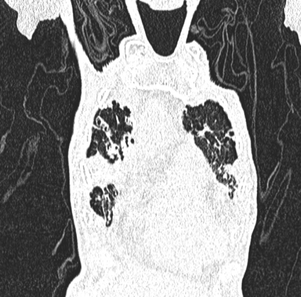 Aspergilloma- with Monod sign (Radiopaedia 44737-48532 Coronal lung window 140).jpg