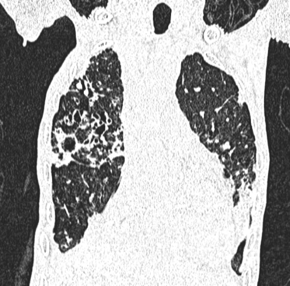File:Aspergilloma- with Monod sign (Radiopaedia 44737-48532 Coronal lung window 188).jpg