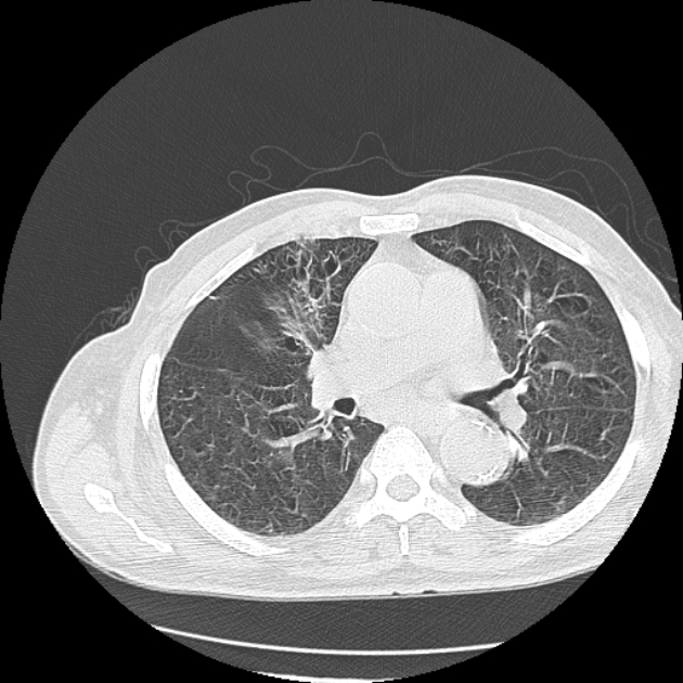 Aspergilloma (Radiopaedia 44592-48327 Axial lung window 40).jpg
