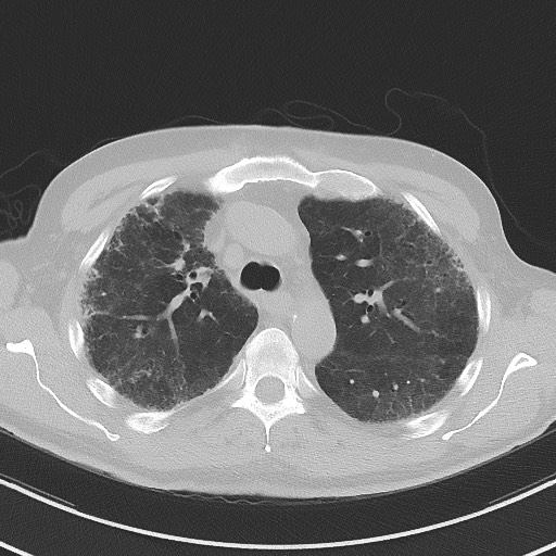 File:Aspergilloma on background pulmonary fibrosis (Radiopaedia 60942-68757 A 19).jpg