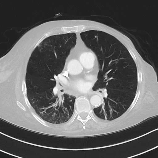 Aspiration bronchiolitis (Radiopaedia 53464-59463 Axial lung window 30).png