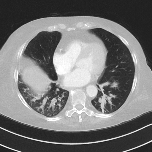 Aspiration bronchiolitis (Radiopaedia 53464-59463 Axial lung window 38).png