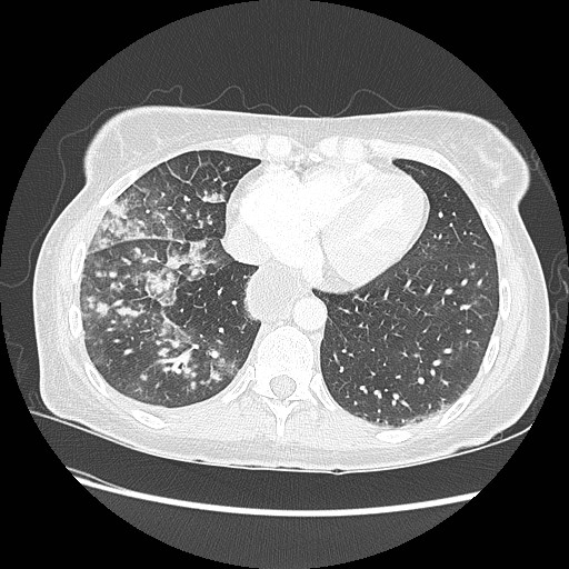 Aspiration pneumonia secondary to laparoscopic banding (Radiopaedia 18345-18183 lung window 82).jpg