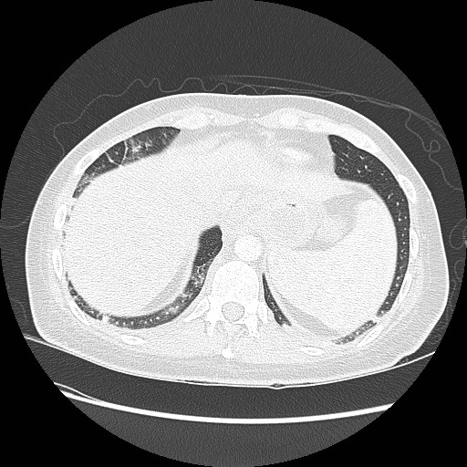 Aspiration pneumonia secondary to laparoscopic banding (Radiopaedia 18345-18183 lung window 95).jpg