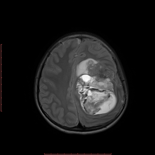 File:Astroblastoma (Radiopaedia 74287-85162 Axial T2 16).jpg