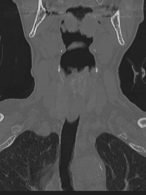 Atlanto-axial subluxation (Radiopaedia 36610-38176 Coronal bone window 4).png