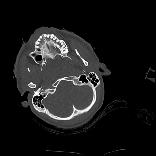 Atlanto-occipital dissociation (Traynelis type 1), C2 teardrop fracture, C6-7 facet joint dislocation (Radiopaedia 87655-104061 Axial bone window 10).jpg