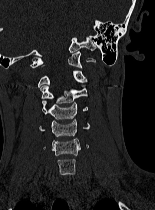 Atlantoaxial subluxation (Radiopaedia 44681-48450 Coronal bone window 57).jpg
