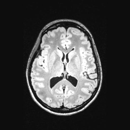 Atretic encephalocoele with inferior vermis hypoplasia (Radiopaedia 30443-31108 Axial 88).jpg
