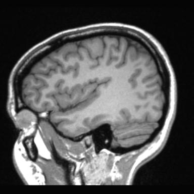 File:Atretic encephalocoele with inferior vermis hypoplasia (Radiopaedia 30443-31108 Sagittal T1 28).jpg