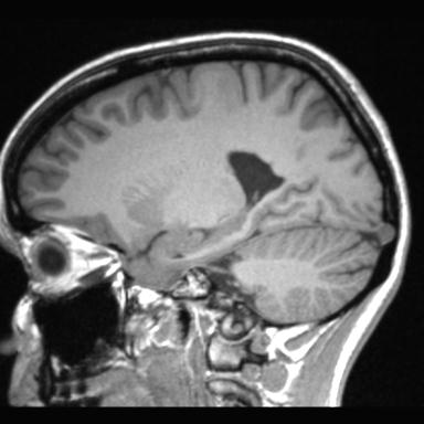 Atretic encephalocoele with inferior vermis hypoplasia (Radiopaedia 30443-31108 Sagittal T1 85).jpg