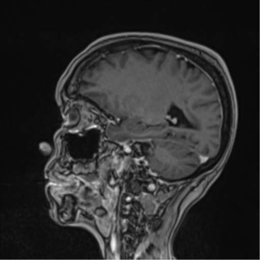 Atypical meningioma (WHO Grade II) (Radiopaedia 54742-60979 Sagittal T1 C+ 27).png