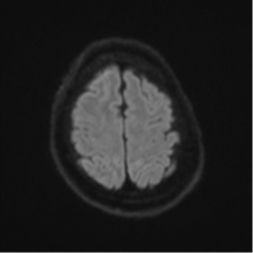 File:Atypical meningioma (WHO Grade II) (Radiopaedia 54742-60981 Axial DWI 51).png