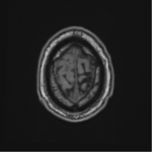 File:Atypical meningioma (WHO grade II) with brain invasion (Radiopaedia 57767-64729 Axial T1 48).png