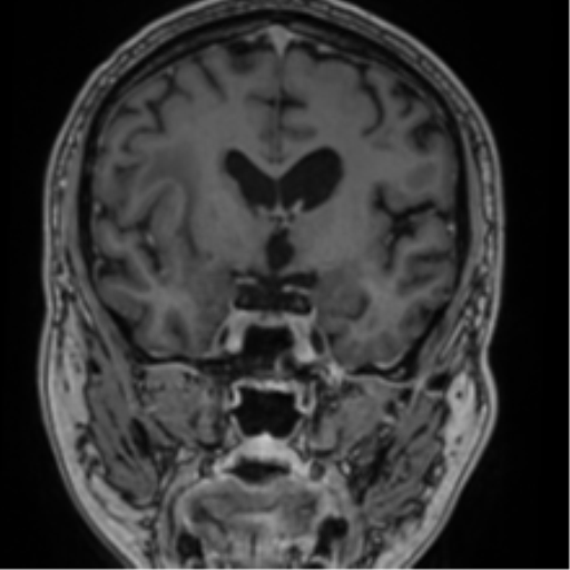 Atypical meningioma (WHO grade II) with brain invasion (Radiopaedia 57767-64729 Coronal T1 C+ 39).png